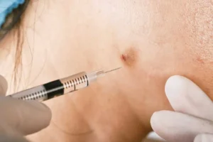 Acne Injections by C2 Aesthetics in Cedar Park, TX